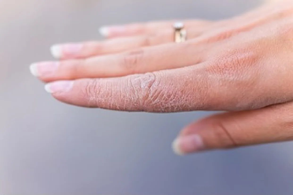 Kışın Cilt Kuruluğu Artıyor! Dermatologlardan Nemlendirme Uyarısı